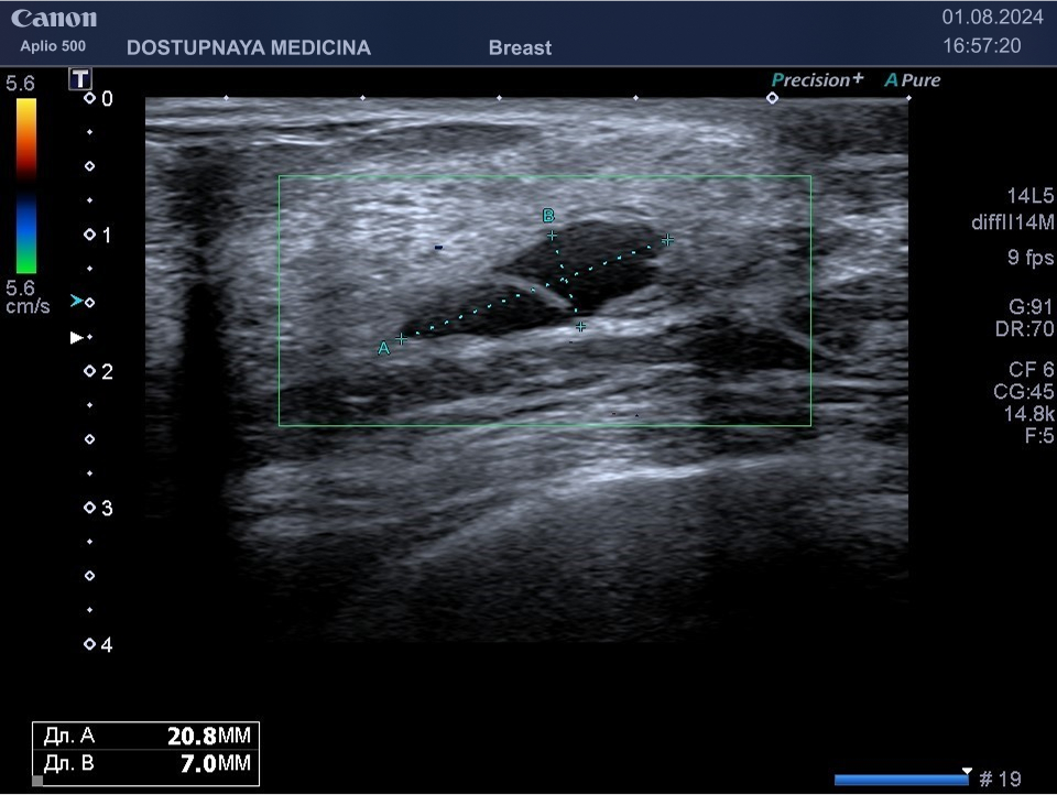 Атипичная киста с перегородкой. Содержимое кисты анэхогенное, кровотока в режиме ЦДК нет, категория BI-RADS 3