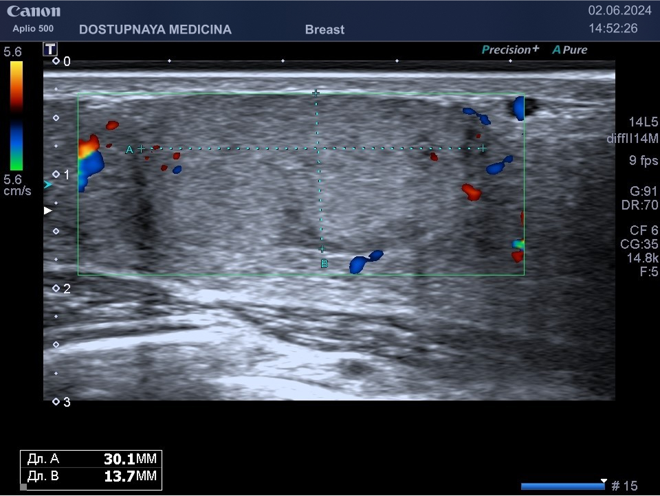 фГалктоцелле больших размеров у 29-летней женщины на 2-м году грудного вскармливания.