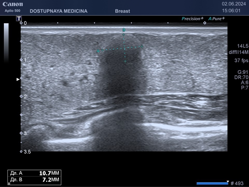 Обызвествление галактоцеле у той же пациентки. При ультразвуковом исследовании мы видим гипоэхогенное образование овальной формы, с ровными и чёткими контурами, с дорсальной акустической тенью.