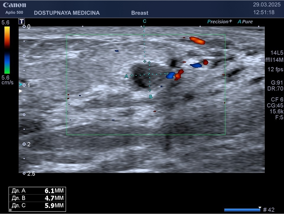 Киста молочной железы с воспалением, кровоток вокруг кисты в режиме ЦДК усилен. Женщина предъявляет жалобы на наличие болезненного уплотнения в области молочной железы, где ранее у неё находили кисту при ультразвуковом исследовании.