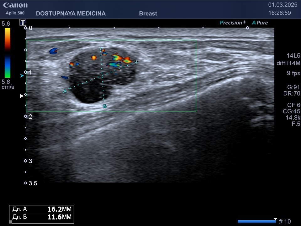 Цистаденопапиллома у 38-летней женщины. На УЗИ молочных желез в кисте с анэхогенным содержимым имеется гипоэхогенный компонент с усиленным кровотоком в режиме ЦДК, категория BI-RADS 4а.