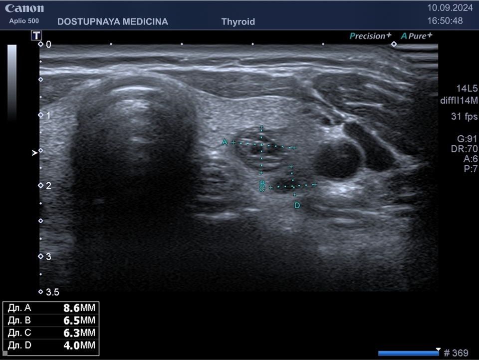 образование солидно-кистозной структуры, гипоэхогенное, овальной формы, с чёткими, ровными контурами, с горизонтальной ориентацией, не нарушающее форму щитовидной железы, категория по TIRADS 3. Учитывая размеры меньше 2.5 см, решено продолжить динамическое наблюдение. Назначен УЗИ контроль через 3 месяца