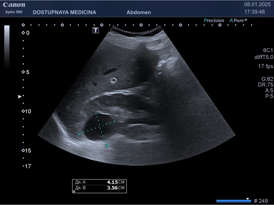 Киста верхнего полюса правой почки