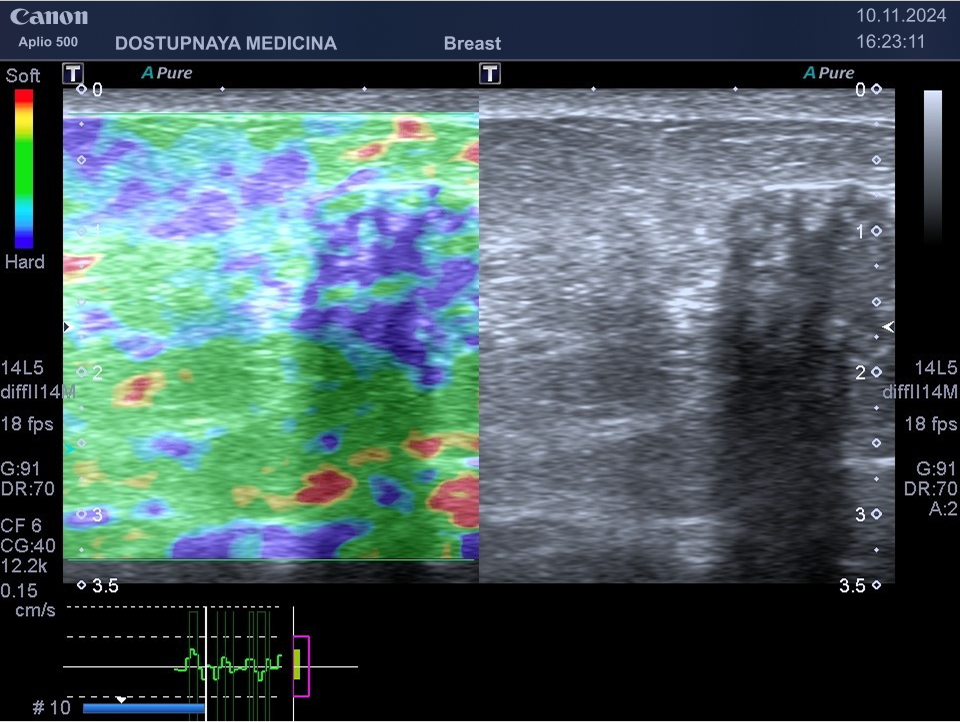 опухоль у той же пациентки, при проведении компрессионной эластографии образования молочной железы, выполненной на УЗ-аппарате CANON (TOSHIBA) APLIO-500, картирование образования однородное, синего цвета, соответствует 4-му типу - по шкале Ueno, незначительно больше по размерам с серошкальным изображением. Эластографическая картина образования соответствует категории BI-RADS V, установленной при выполнении УЗИ в В-режиме.