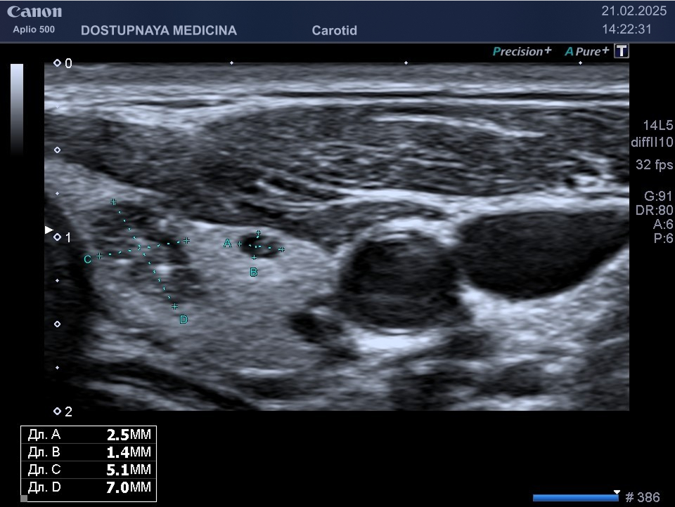 образование солидной структуры, гипоэхогенное, овальной формы, с чёткими, ровными контурами, с горизонтальной ориентацией, не нарушающее форму щитовидной железы, с единичными микрокальцинатами, категория по TIRADS 5. Учитывая размеры меньше 1 см и нормальный уровень кальцитонина в крови, решено продолжить динамическое наблюдение. Назначен УЗИ контроль через 1 месяц