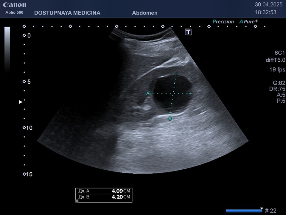 Парапельвикальная киста нижнего полюса правой почки.