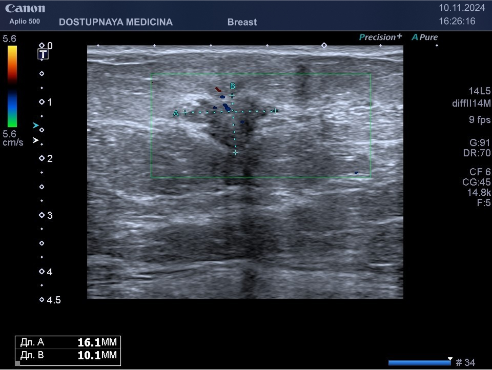 случайно выявленное образование в молочной железе у 45-летней женщины на маммографии во время диспансеризации, направлена на УЗИ молочных желез для уточнения диагноза, при ультразвуковом исследовании гипоэхогенное образование звёздчатой формы, с нечётким и неровным контуром, с неопределённой пространственной ориентацией, с единичными локусами кровотока в режиме ЦДК, дающее дорсальную акустическую тень, категория по BI-RADS V. Злокачественный характер опухоли затем подтверждён гистологическим исследованием после трепан-биопсии.