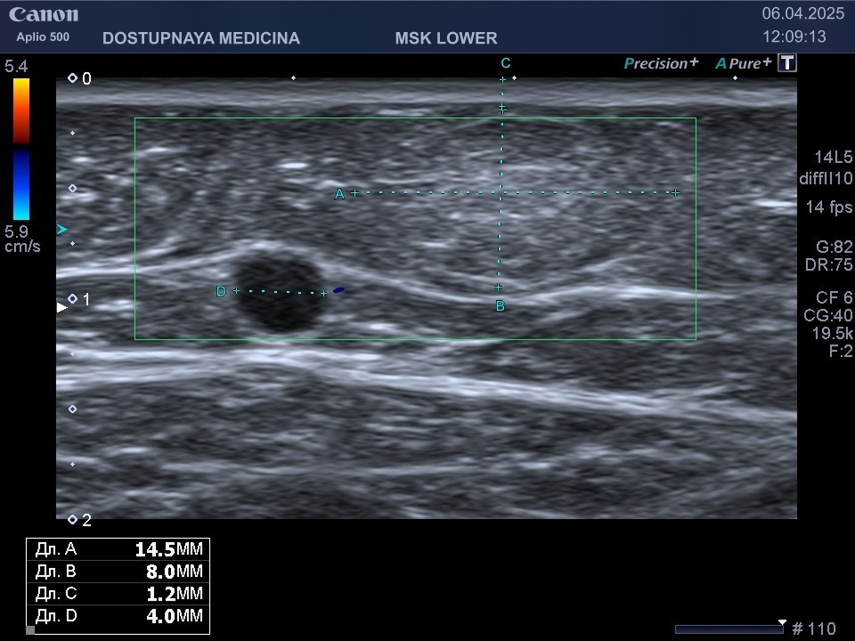 Липома в верхней трети бедра рядом с большой подкожной веной бедра