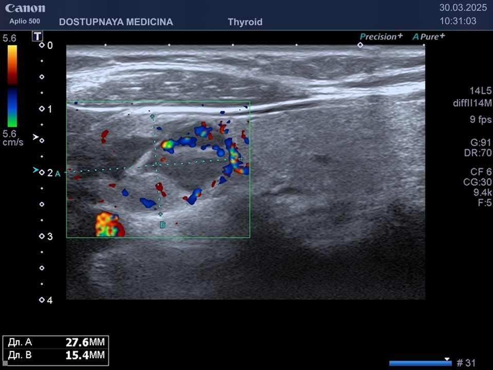 образование кистозно-солидной структуры, изоэхогенное, овальной формы, с не чёткими, не ровными контурами, с горизонтальной ориентацией, не нарушающее форму щитовидной железы, категория по TIRADS 4. Учитывая размеры больше 1.5 см выполнена тонкоигольная пункционная биопсия, при цитологическом исследовании раковых клеток не выявлено, рекомендовано продолжить динамическое наблюдение