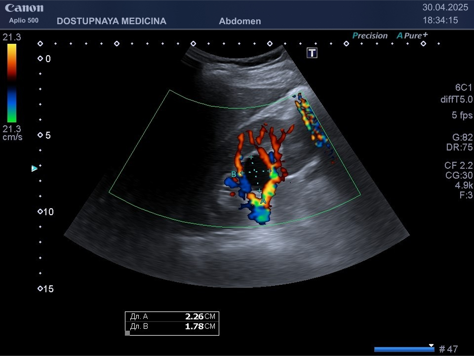 Парапельвикальная киста правой почки. В режиме ЦДК видно, что киста оттесняет кровеносные сосуды почки, но полностью их пока что не сдавливает.