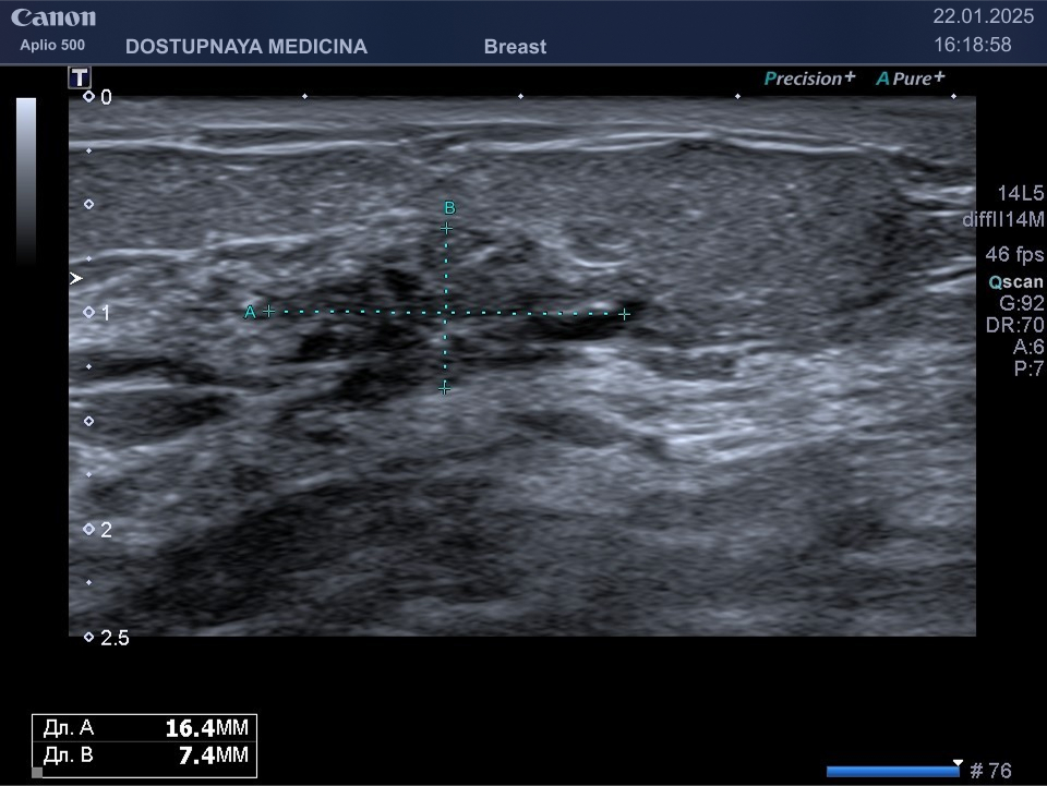 Пациентка 64 лет, опухоль выявлена ранее на мамографии, подтверждена гистологическим исследованием после трепан-биопсии под УЗИ наведением, прошла три курса неоадъювантной предоперационной химиотерапии, при контрольном УЗИ отмечается уменьшение опухоли в размерах на 6 мм по сравнению с данными предыдущего ультразвукового исследования.