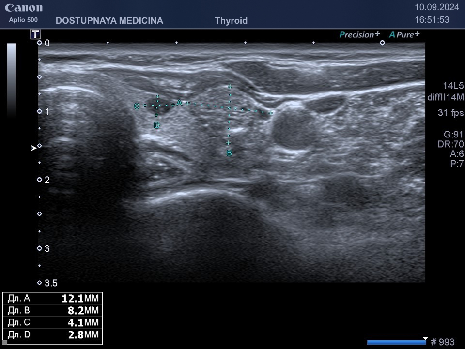 образование солидной эхоструткуры, изоэхогенное, с единичными микрокальцинатами, с ровными не чёткими контурами, с неопределённой пространственной ориентацией, нарушающее контур житовидной железы ( видно, что образование приподнимает прилежащую мышцу, в большинстве случаев это означает, что образование плотное), категория TIRADS 5