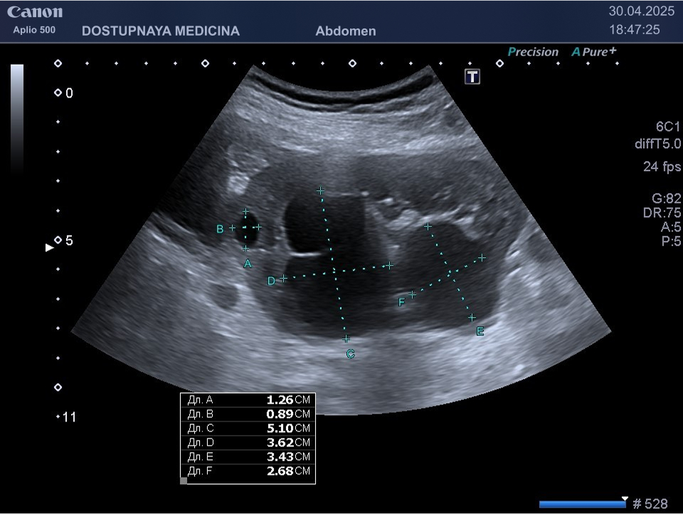 Множественные кисты левой почки у 32-летней женщины с отягощённым семейным анамнезом по поликистозной болезни почек (мать этой пациентки оперирована по поводу множественных кист почки). На последнем ультразвуковом исследовании три года назад были выявлены только две небольшие кисты в левой почке и одна в правой.