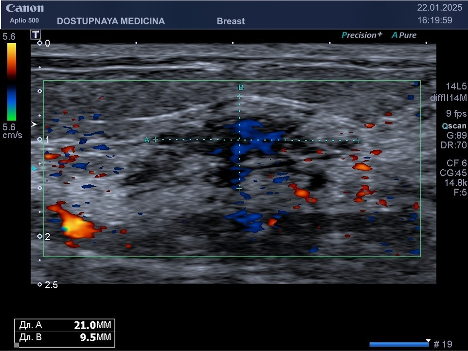 Опухоль у той же пациентки в режиме ЦДК