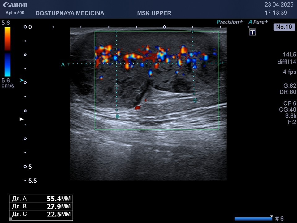Опухоль у той же женщины в режиме ЦДК. Видно, что кровоток в образовании значительно усилен