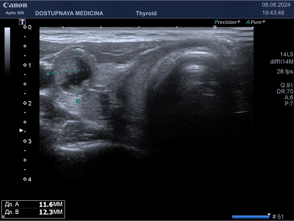 образование солидно-кистозной эхоструткуры, изоэхогенное, с ровными не чёткими контурами, с неопределённой вертикальной ориентацией, нарушающее контур житовидной железы ( видно, что образование приподнимает прилежащую мышцу, в большинстве случаев это означает, что образование плотное), категория TIRADS 4