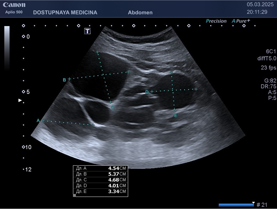 Полная кистозная трансформация левой почки у 55-летнего мужчины. Последнее ультразвуковое исследование около пяти лет назад. В настоящее время почечная ткань полностью отсутствует и замещена множественными кистами. В таких случаях необходимо оперативное лечение.