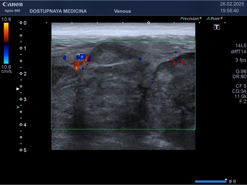 Рабдомиосаркома в средней трети бедра у мужщины 38-лет. Опухоль верифицирована гистологически