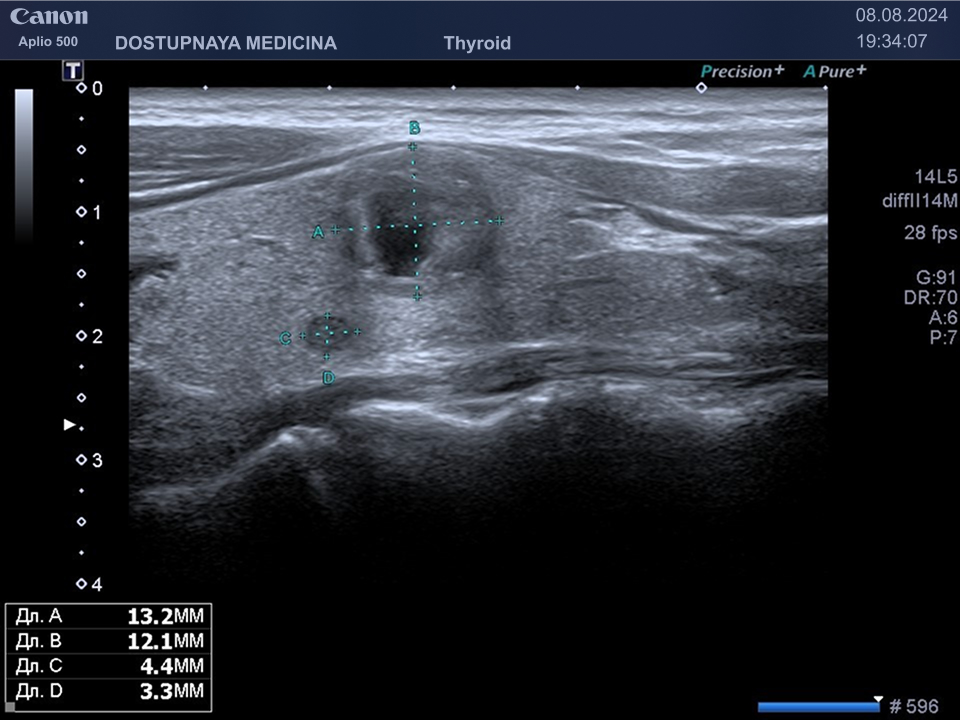 образование у того же пациента в продольном сечении щитовидной железы