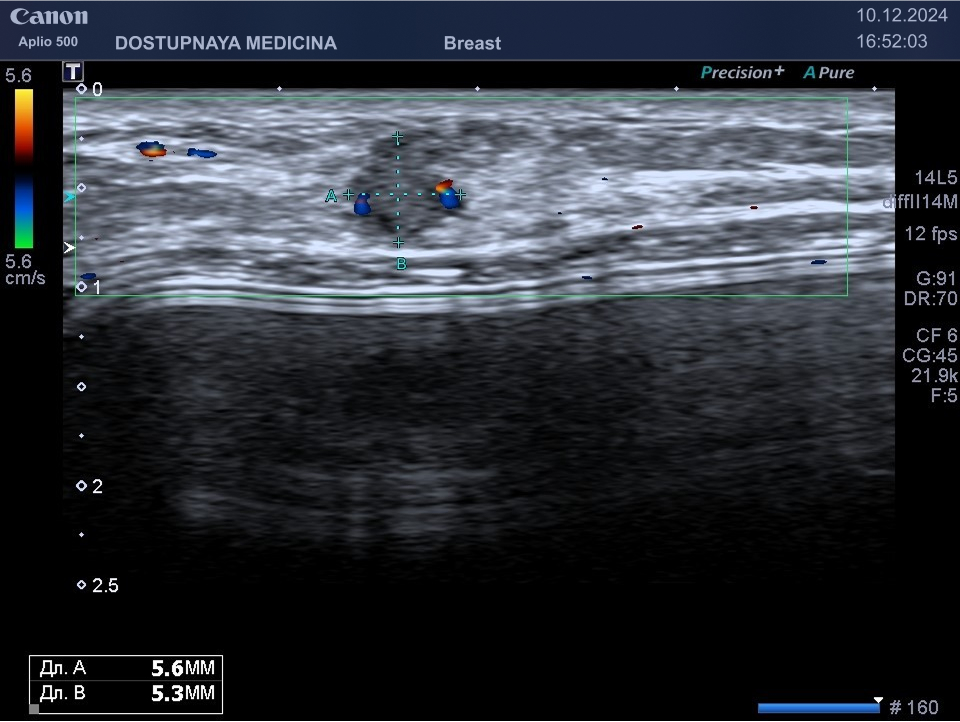 Пациентка 27 лет, состояние после увеличивающей маммопластики с установкой силиконового импланта под большую грудную мышцу около 2 лет назад. Около 5 дней назад появилось болезненное уплотнение в молочной железе, ранее со слов находили кисты молочной железы до и после операции. При обращении к нам в клинику во время ультразвукового исследования визуализируется гипоэхогенное образование неправильной полигональной формы, с неопределённой пространственной ориентацией (образование находится в тонкой прослойке ткани между кожей и большой грудной мышцей), с единичными локусами кровотока в режиме ЦДК, дорсальные акустические эффекты оценить сложно, так как образование находится непосредственно на грудной мышце, а далее находится имплант, по совокупности эхографических признаков выставлена категория BI-RADS IVb. С учётом анамнеза и клиники не исключается наличие воспалительного инфильтрата, который может давать такую же картину при ультразвуковом исследовании. При подозрении на воспалительный инфильтрат допускается назначение НПВС и антибиотикотерапии, затем необходим УЗИ контроль молочных желез не позднее чем через две недели, при отсутствии положительной динамики необходимо провести трепан-биопсию такого образования, так как в таком случае нельзя исключить рак молочной железы. У данной пациентки образование удалено, при гистологическом исследовании выявлена типичная и атипичная гиперплазия внутрипротокового эпителия, фиброз и гиалиноз стромы. По гистологическому заключению образование оказалось доброкачественное, но с высоким риском малигнизации.