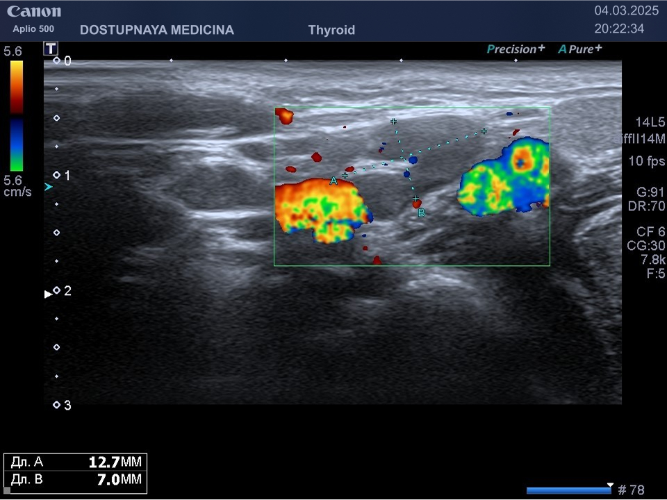 Лимфаденопатия подчелюстных лимфоузлов по воспалительному типу у 18-летней девушки с хроническим тонзиллитом в анамнезе