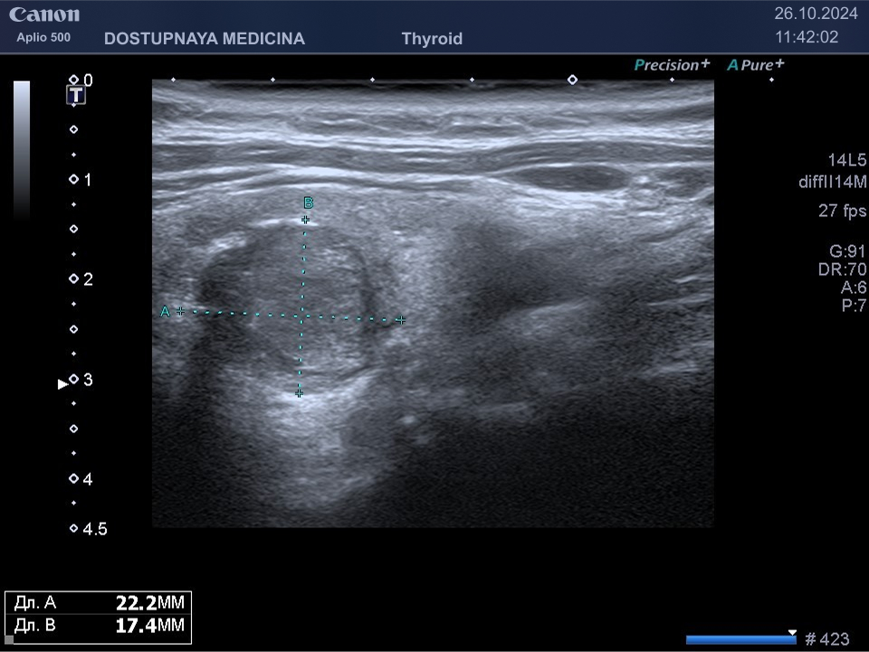 образование солидной эхоструткуры, гипоэхогенное, с не ровными не чёткими контурами, с неопределённой пространственной ориентацией, нарушающее контур житовидной железы, с периферической кальцификацией, категория TIRADS 5