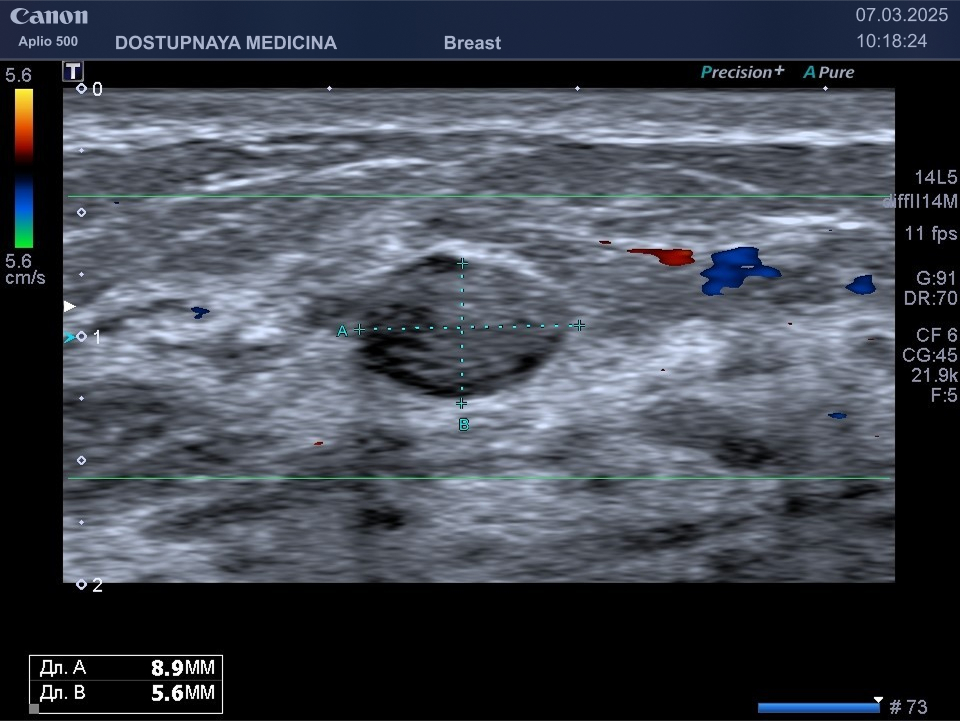 Фиброаденома у 25-летней женщины без увеличения в размерах в течение 2-х лет наблюдения. Три года назад проводилось удаление двух фиброаденом. Эту вновь возникшую фиброаденому решено наблюдать.
