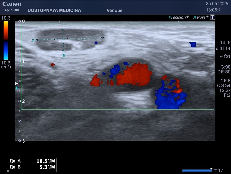 Лимфаденопатия пахового лимфатического узла справа по воспалительному типу у 28-летнего мужщины с фурункулом на правом бедре.