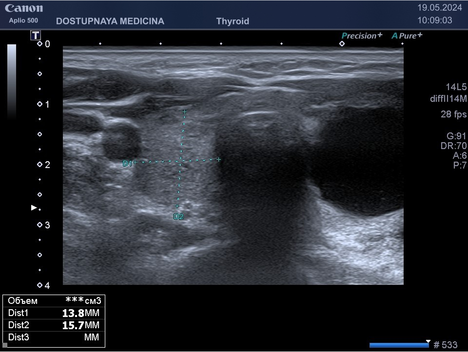 в правой доле щитовидной железы солидный изоэхогенный узел с вертикальной пространственной ориентацией, категория TIRADS 4 и кистозно-солидный изоэхогенный узел с неопределённой пространственной ориентацией, нарушающий форму щитовидной железы, с единичными микрокальцинатами, категория TIRADS 5