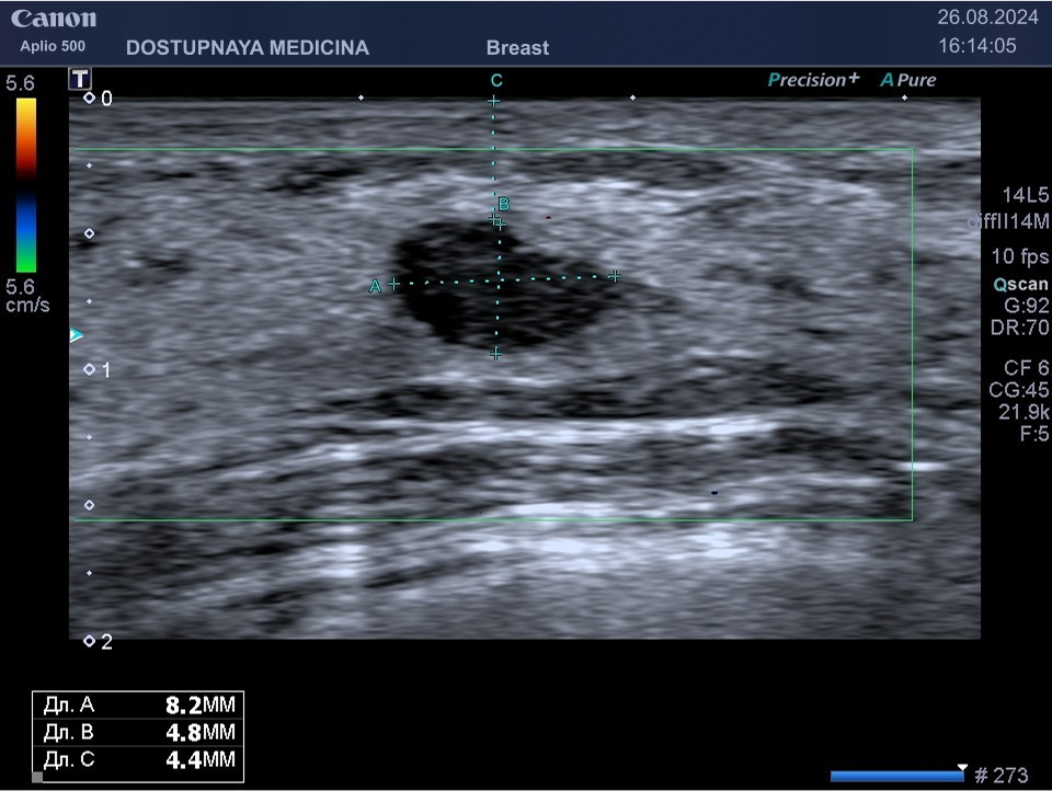 Фиброаденома у 35 летней женщины. По желанию пациентки опухоль была удалена.