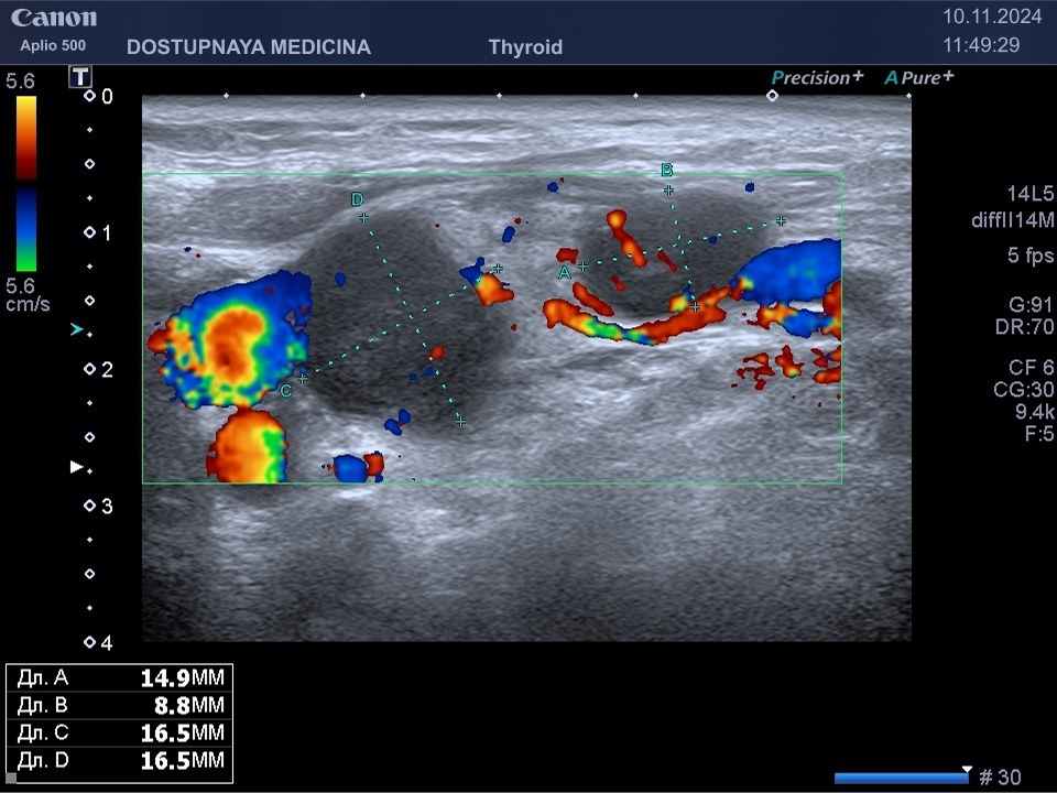 Метастазы рака яичника в подключичные лимфатические узлы слева, так называемые метастазы Вирхова.